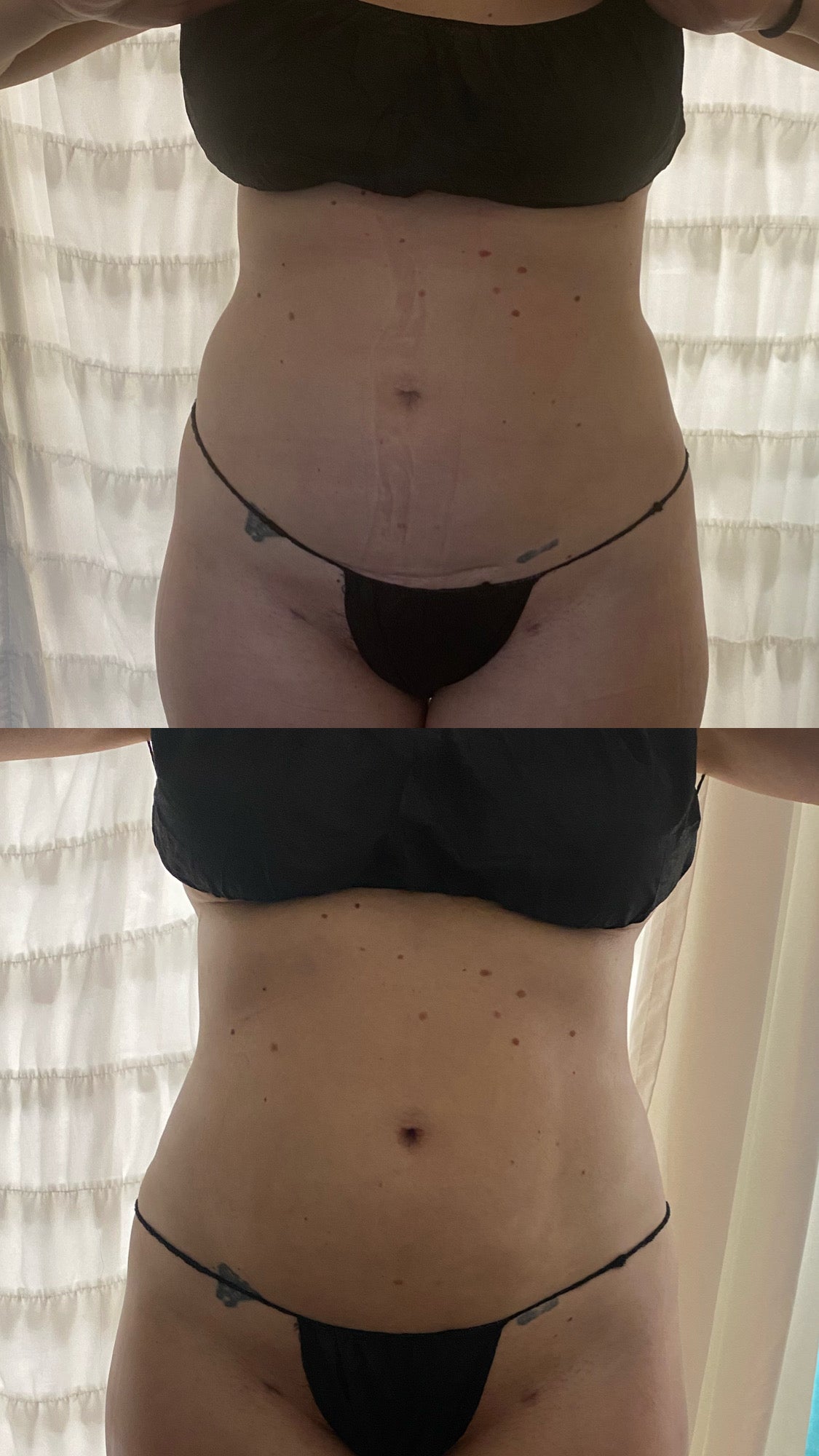 Kurvelux Post Surgery Package 20 (60 minute Sessions)+ Coplimentary 2nd Stage Post Op Faja + Alastin Recovery Cream & Scar Tape
