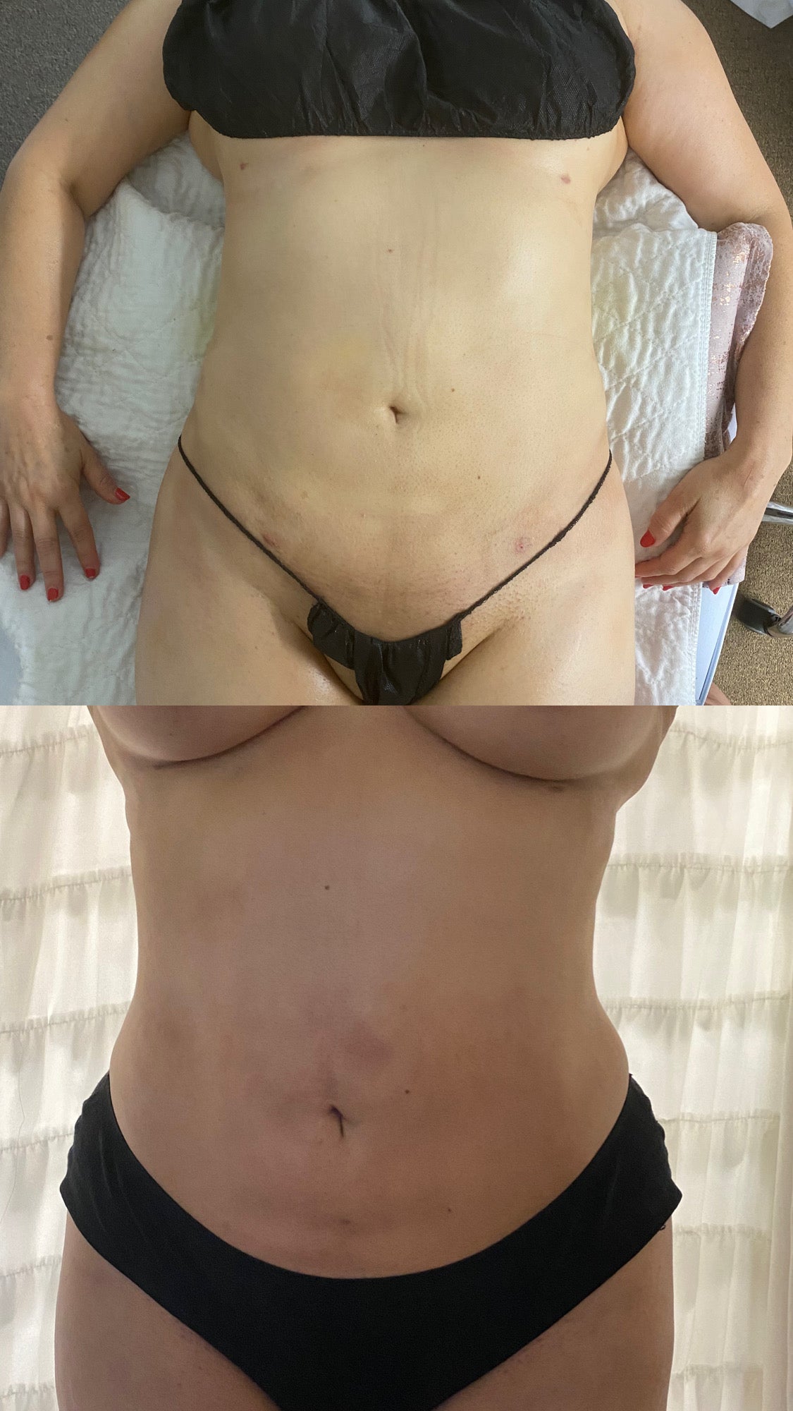 Kurvelux Post Surgery Package 20 (60 minute Sessions)+ Coplimentary 2nd Stage Post Op Faja + Alastin Recovery Cream & Scar Tape
