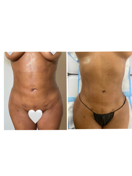 KURVELUX Post Op Surgery Package 10 (60 minute Sessions) + Free 2nd Stage Post Op Faja