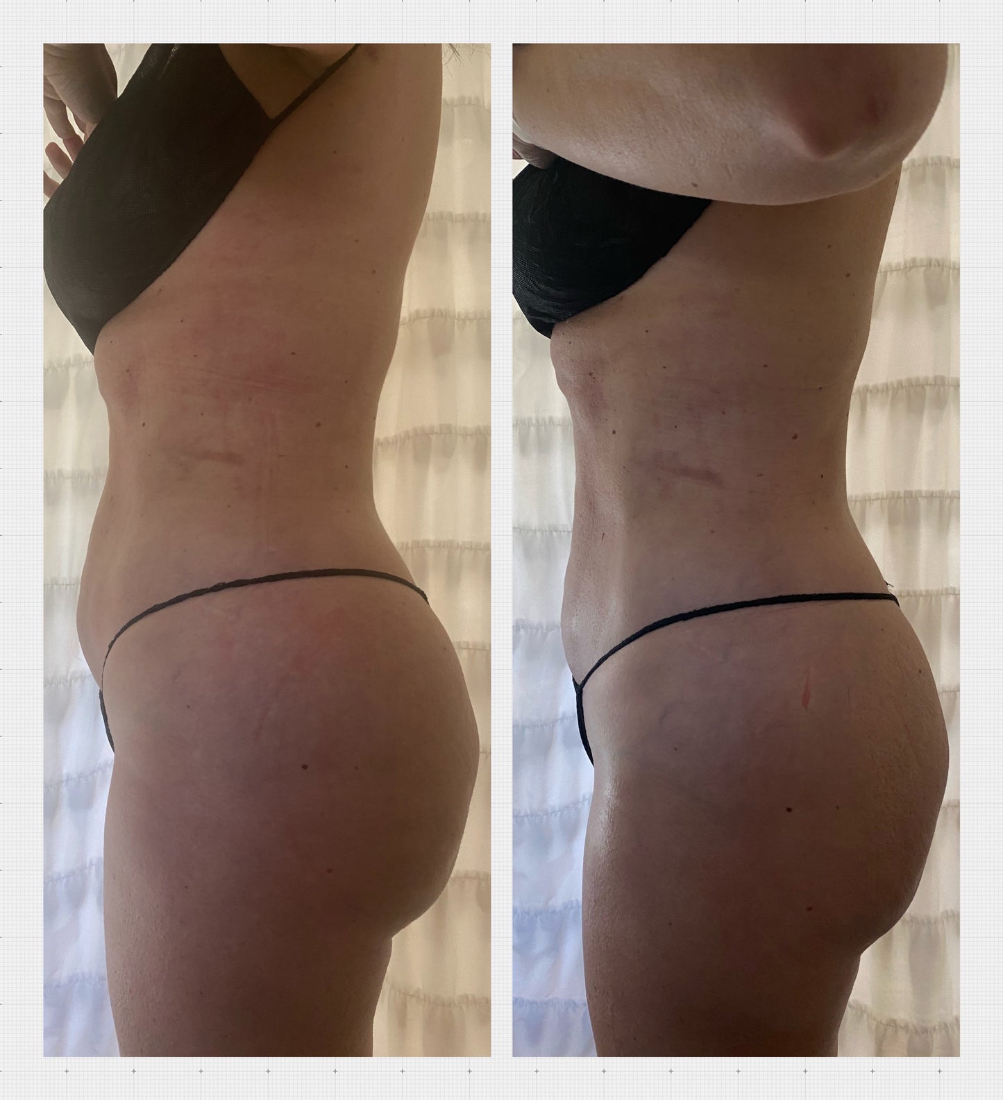 KURVELUX Post Op Surgery Package 10 (60 minute Sessions) + Free 2nd Stage Post Op Faja