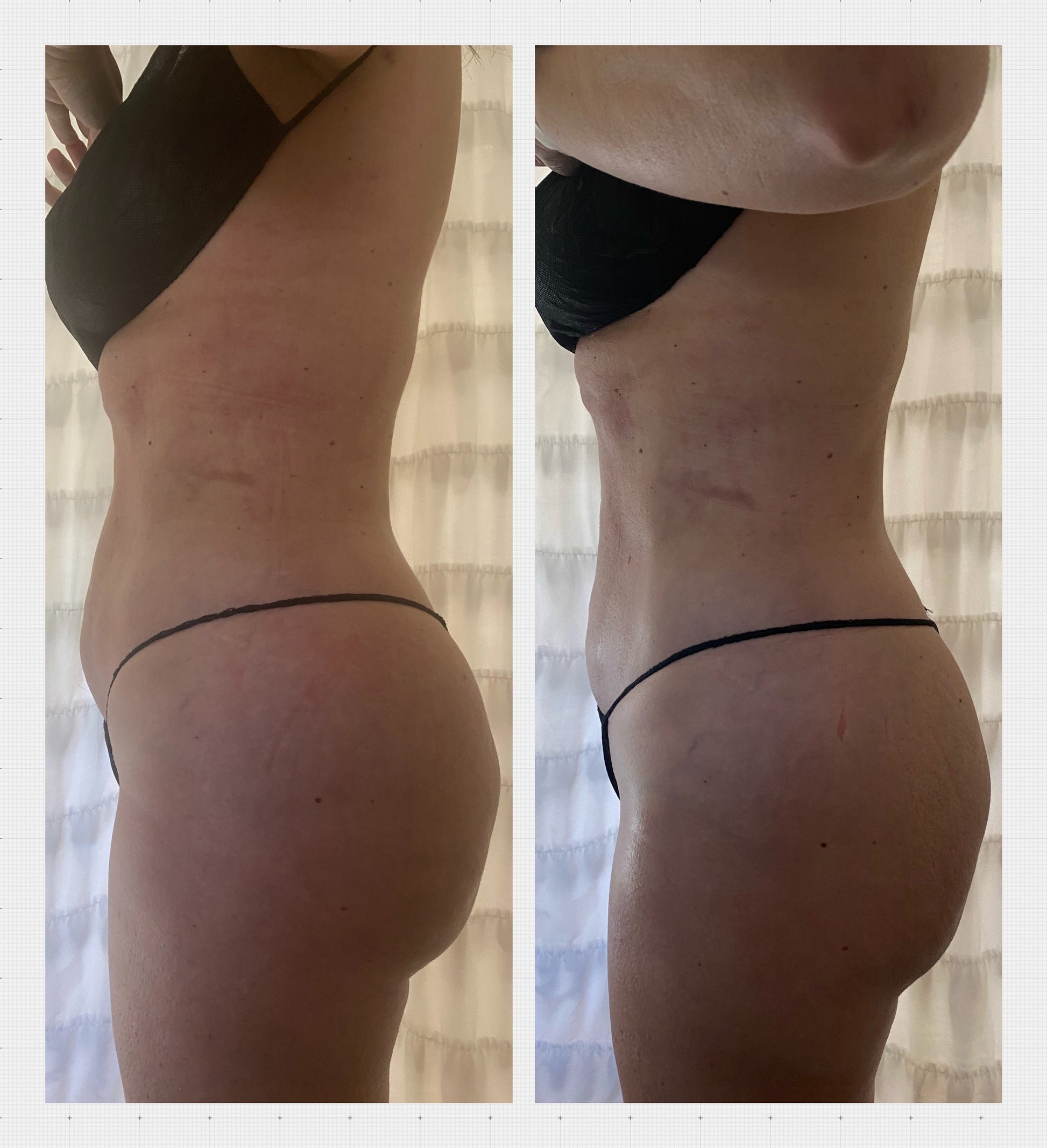 KURVELUX Post Op Surgery Package 10 (60 minute Sessions) + Free 2nd St –  KIMMI COUTURE