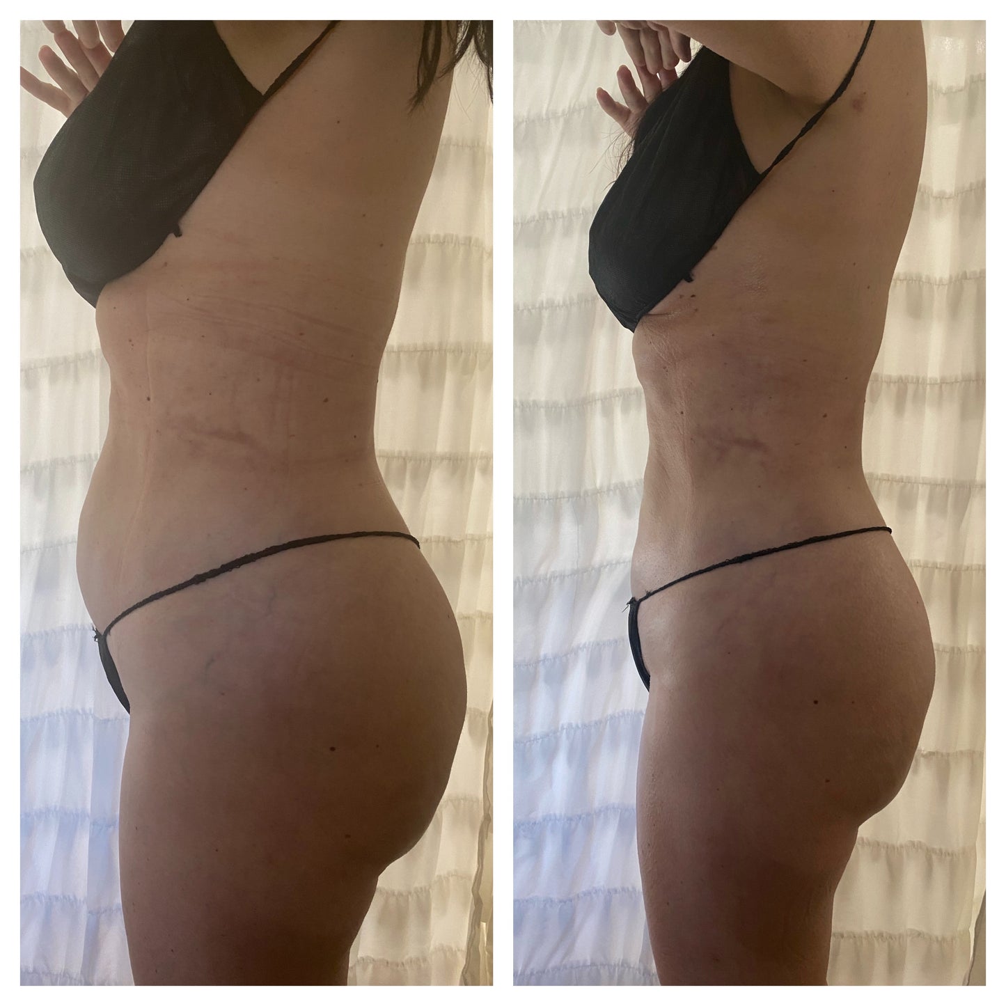 Kurvelux Post Surgery Package 20 (60 minute Sessions) + Free 2nd Stage Post Op Faja